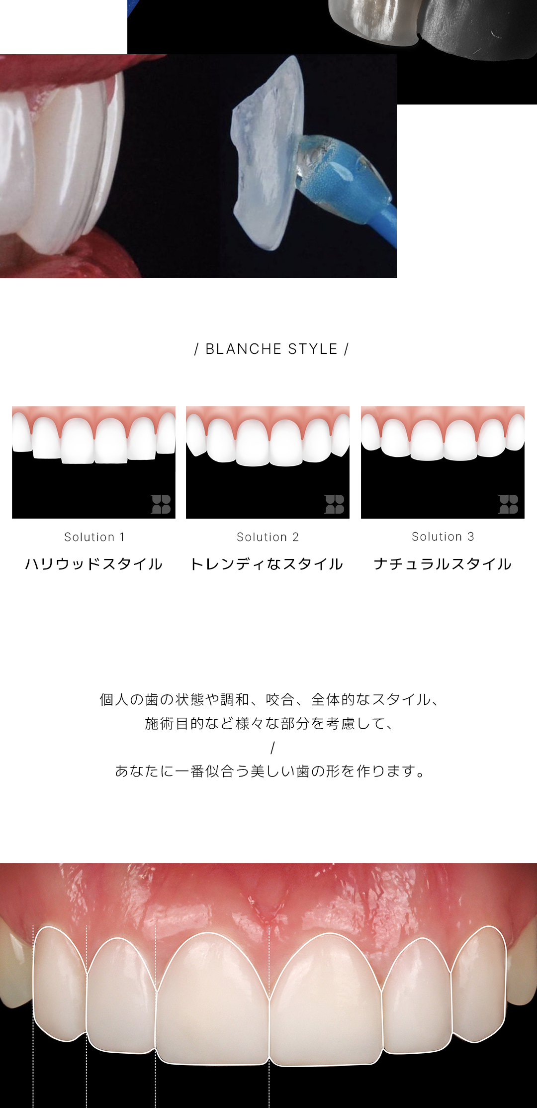 Laminate không mài | Blanche Dental | Hướng tới răng trắng tự nhiên với Veneer siêu mỏng 0,01mm | Seoul Gangnam