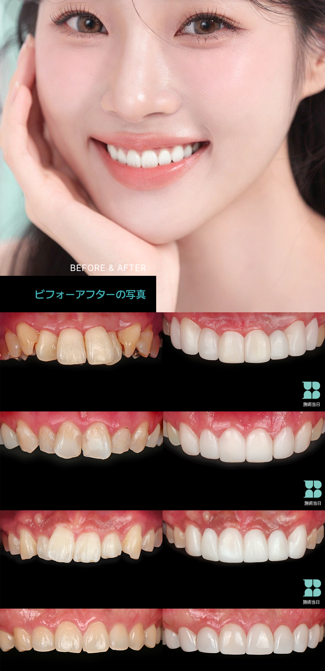 Laminate không mài | Blanche Dental | Hướng tới răng trắng tự nhiên với Veneer siêu mỏng 0,01mm | Seoul Gangnam
