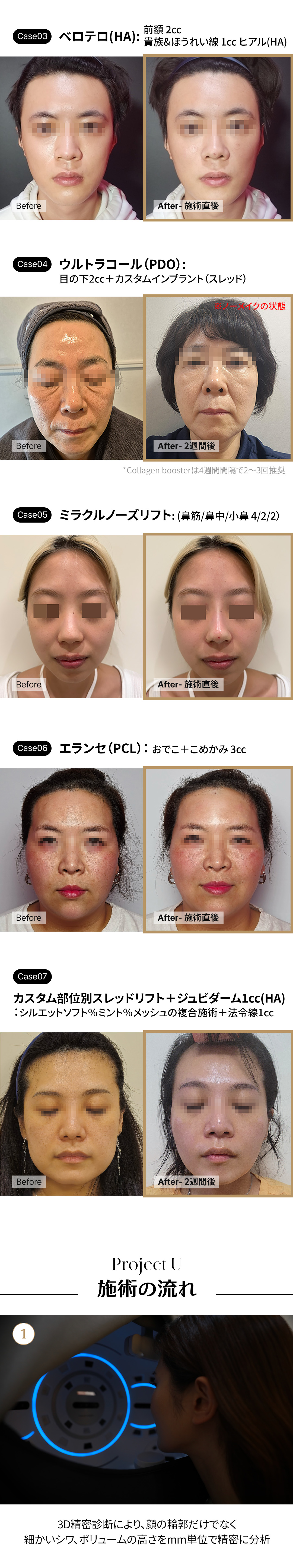 Thủ thuật Hyaluronic Acid tùy chỉnh tại Project You Clinic Hongdae, Seoul Hàn Quốc | Điều trị filler 1:1 bằng chẩn đoán chính xác 3D x viện trưởng đại diện