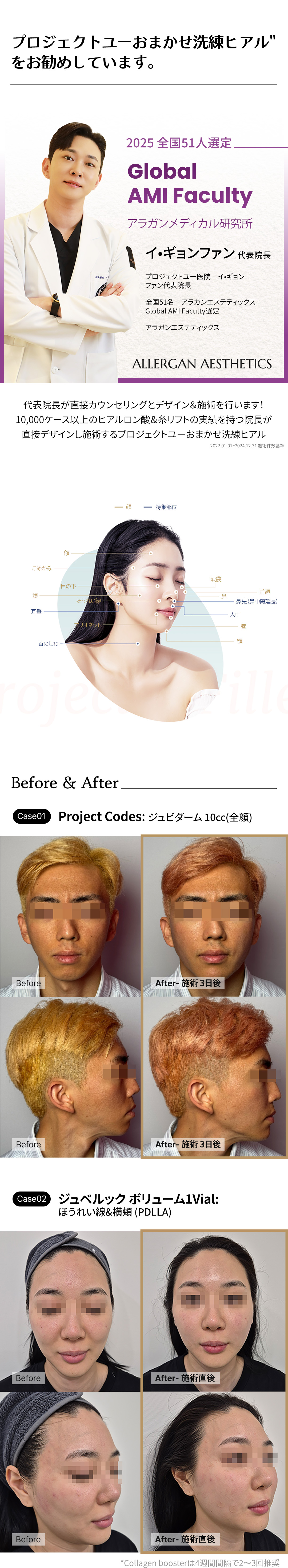 Thủ thuật Hyaluronic Acid tùy chỉnh tại Project You Clinic Hongdae, Seoul Hàn Quốc | Điều trị filler 1:1 bằng chẩn đoán chính xác 3D x viện trưởng đại diện