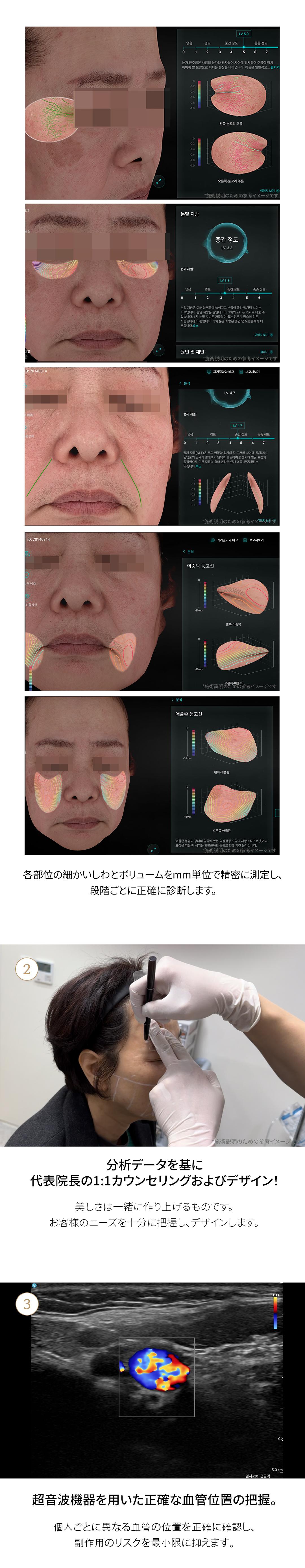 Thủ thuật Hyaluronic Acid tùy chỉnh tại Project You Clinic Hongdae, Seoul Hàn Quốc | Điều trị filler 1:1 bằng chẩn đoán chính xác 3D x viện trưởng đại diện