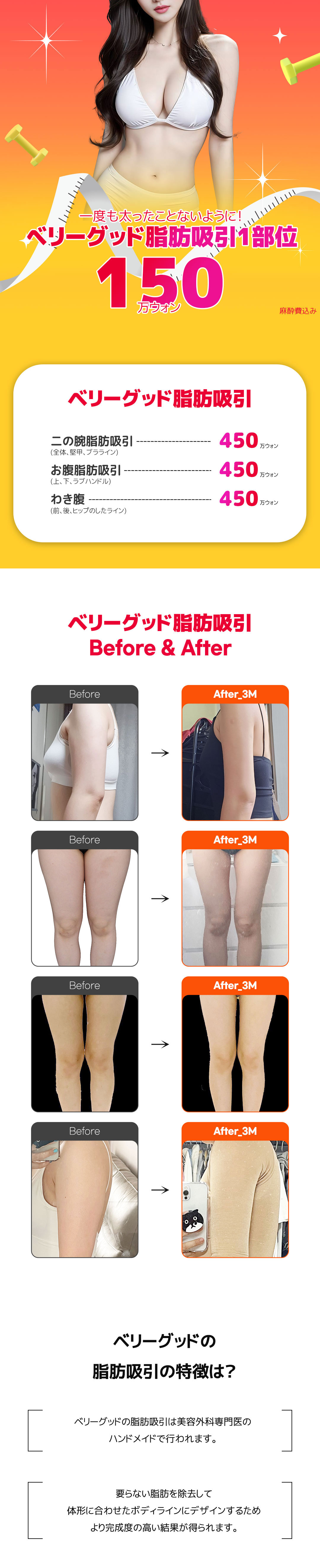 Hút mỡ hướng tới đường viền cơ thể lý tưởng｜Hàn Quốc Very Good Plastic Surgery｜Ga Gangnam 1 phút・thủ thuật bác sĩ chuyên khoa