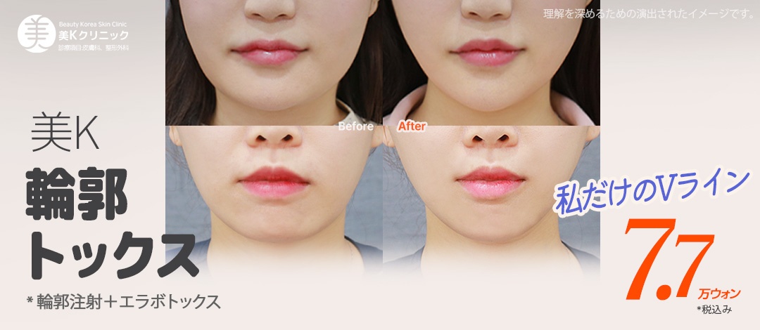 V-line Contour Tox｜Hướng đến gọn mặt bằng Botox hàm + tiêm tan mỡ｜Phòng khám Mikei ga Gangnam Seoul