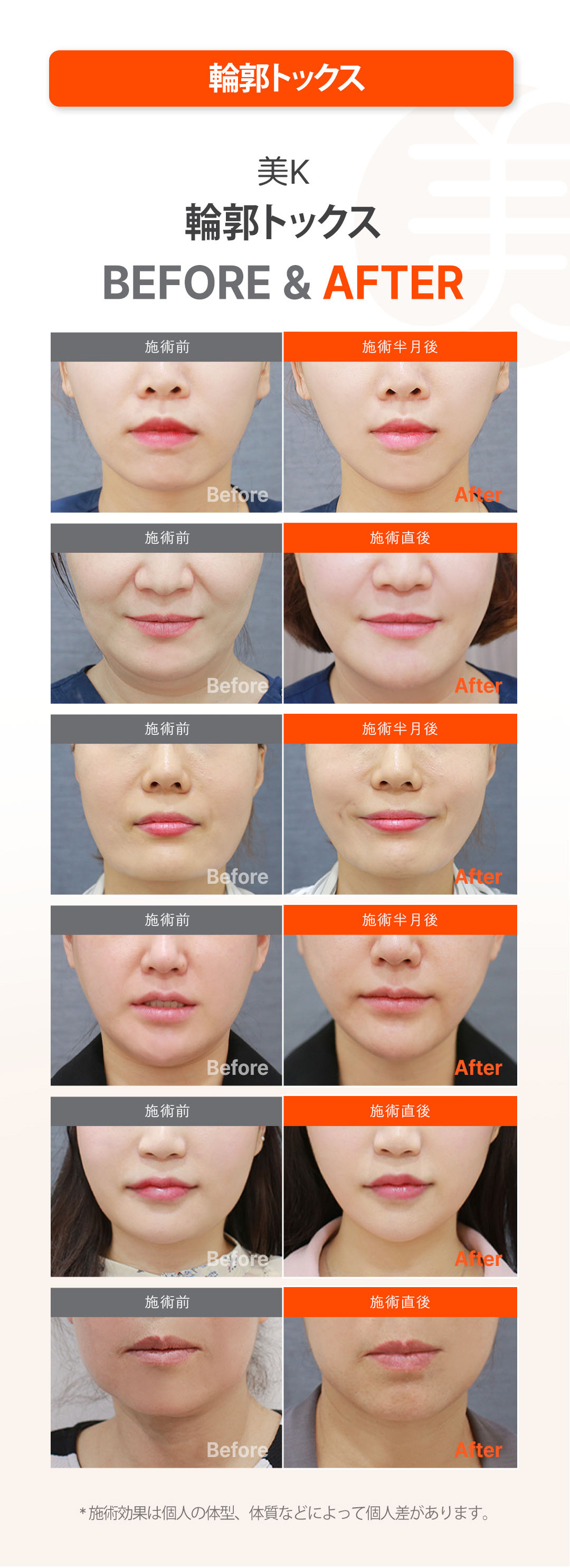 V-line Contour Tox｜Hướng đến gọn mặt bằng Botox hàm + tiêm tan mỡ｜Phòng khám Mikei ga Gangnam Seoul