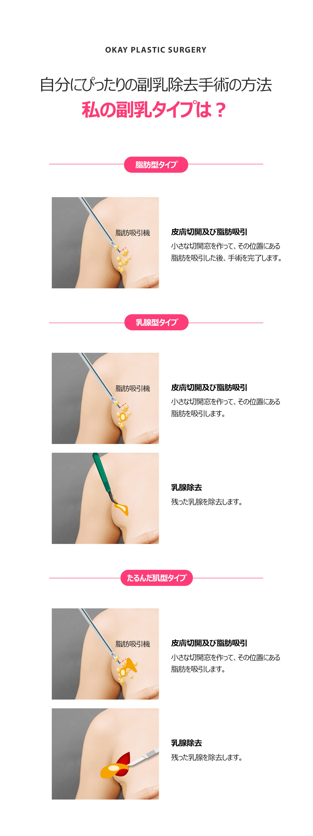 Phẫu thuật loại bỏ nách phụ Quick One Day | Liệu trình trong ngày hướng đến cải thiện đường nách | Cheongdam OK Thẩm mỹ Ngoại khoa