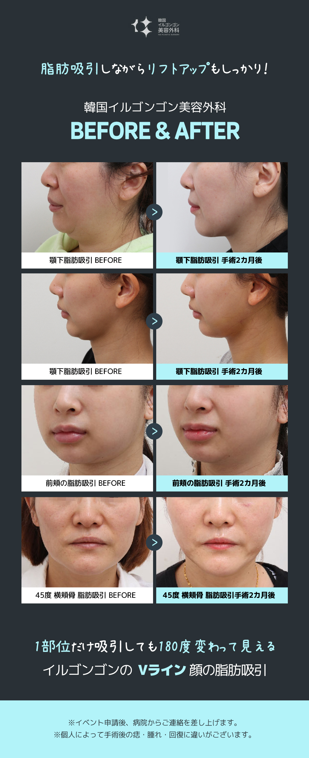 Hút mỡ mặt V-line nhằm V-line | Tạo hình khuôn mặt không dao từ 250.000 won | Ilgongong Plastic Surgery | Ga Apgujeong