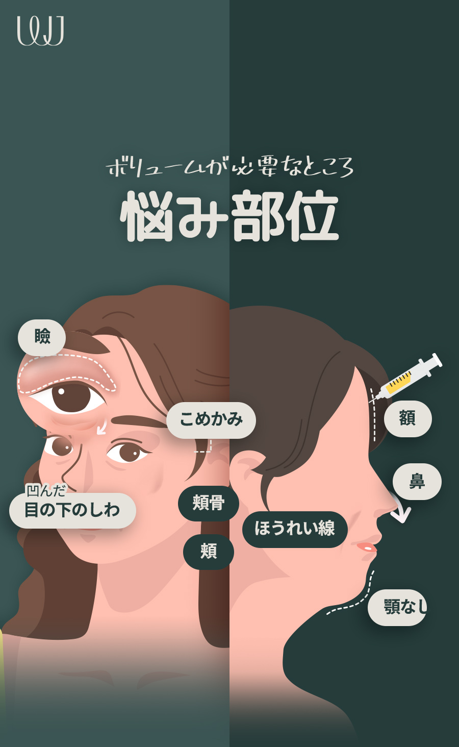 Ghép mỡ toàn mặt phục hồi volume｜PRP tế bào gốc nâng cao tỷ lệ sống sót｜Hàn Quốc Seoul Gangnam WJ Wonjin Plastic Surgery