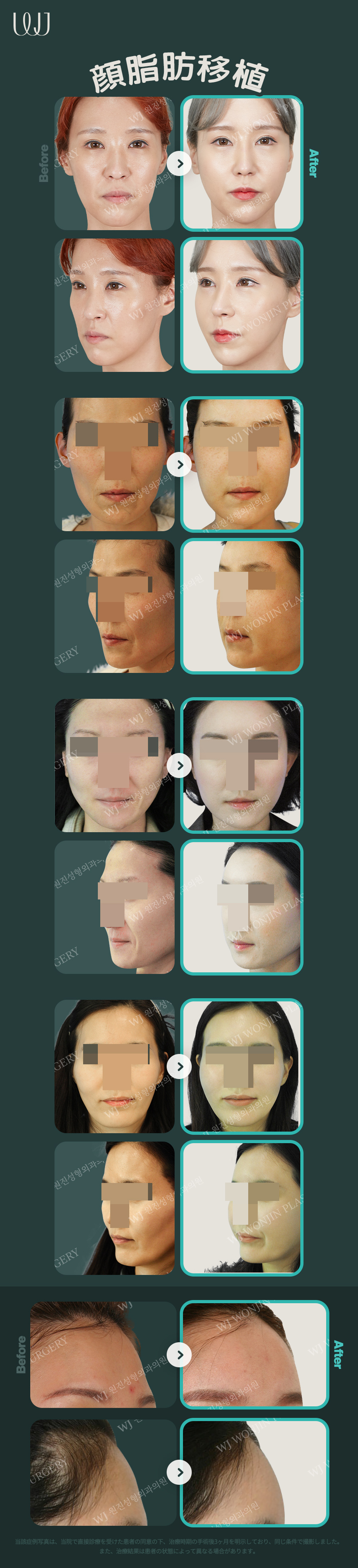 Ghép mỡ toàn mặt phục hồi volume｜PRP tế bào gốc nâng cao tỷ lệ sống sót｜Hàn Quốc Seoul Gangnam WJ Wonjin Plastic Surgery