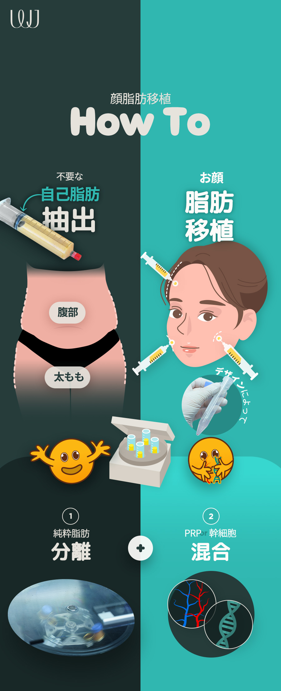 Ghép mỡ toàn mặt phục hồi volume｜PRP tế bào gốc nâng cao tỷ lệ sống sót｜Hàn Quốc Seoul Gangnam WJ Wonjin Plastic Surgery