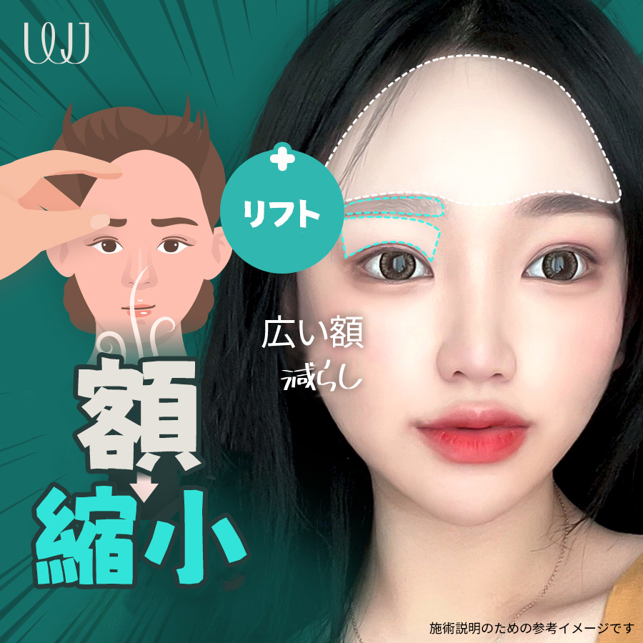 Hướng đến cải thiện trán rộng với phẫu thuật thu nhỏ trán｜Chỉnh sửa đường chân tóc đồng thời｜WJ Wonjin Thẩm mỹ (ga Gangnam)