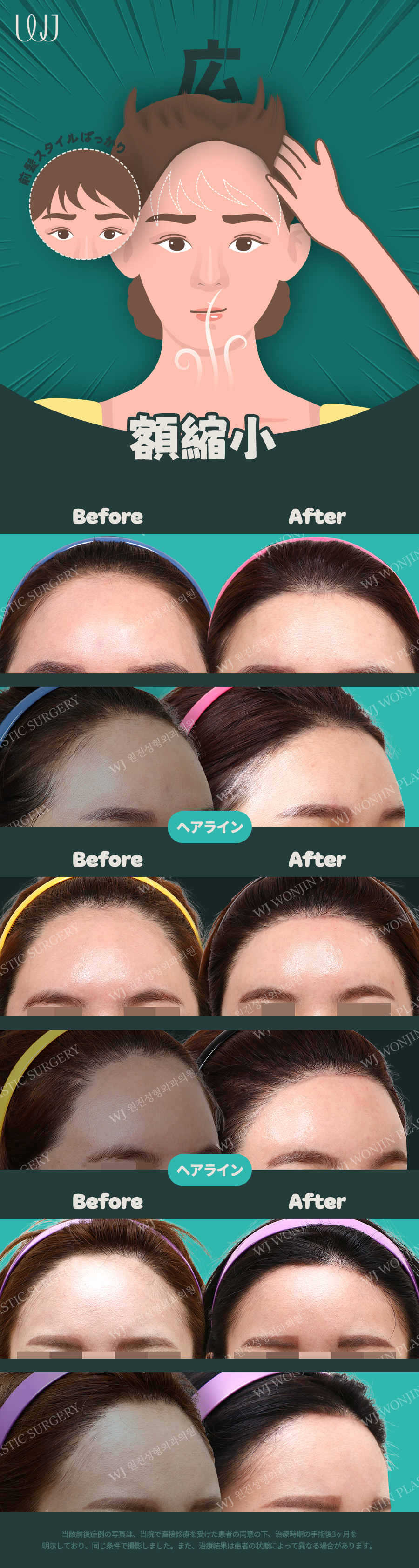 Hướng đến cải thiện trán rộng với phẫu thuật thu nhỏ trán｜Chỉnh sửa đường chân tóc đồng thời｜WJ Wonjin Thẩm mỹ (ga Gangnam)