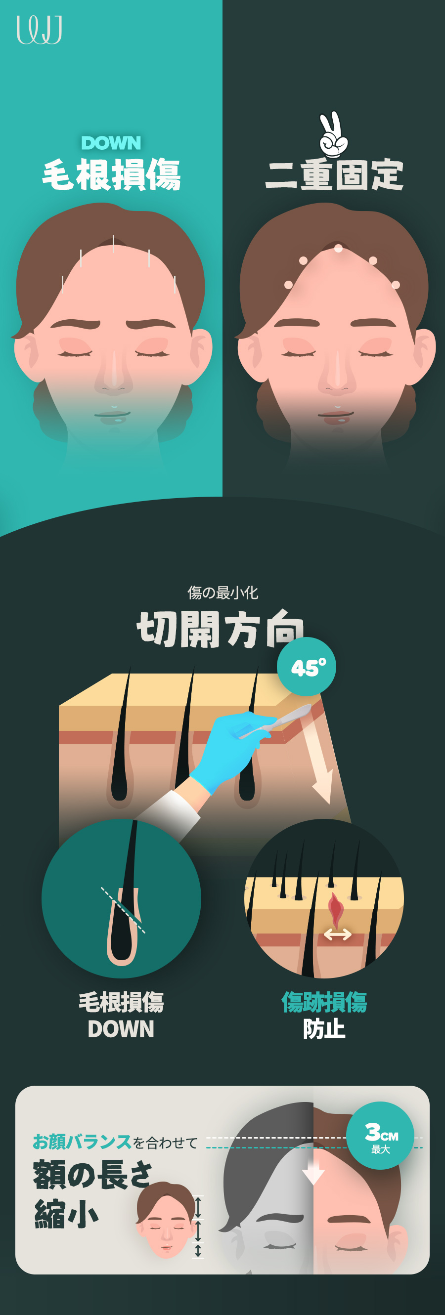 Hướng đến cải thiện trán rộng với phẫu thuật thu nhỏ trán｜Chỉnh sửa đường chân tóc đồng thời｜WJ Wonjin Thẩm mỹ (ga Gangnam)