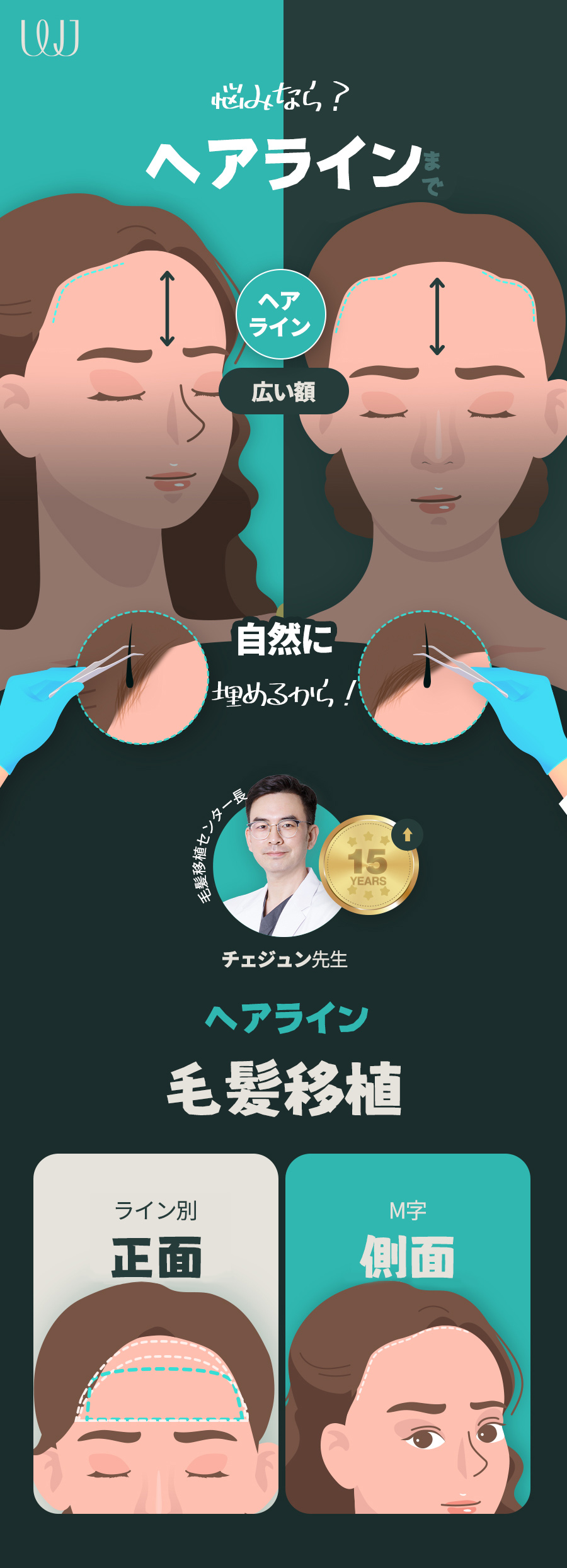 Hướng đến cải thiện trán rộng với phẫu thuật thu nhỏ trán｜Chỉnh sửa đường chân tóc đồng thời｜WJ Wonjin Thẩm mỹ (ga Gangnam)