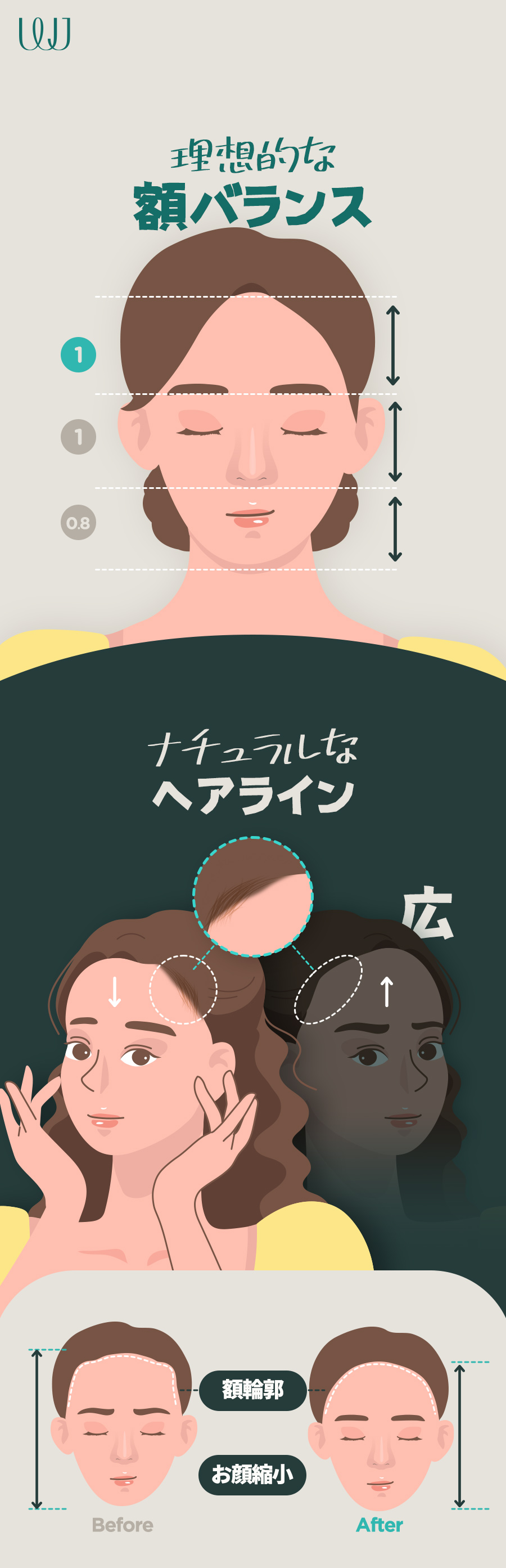 Hướng đến cải thiện trán rộng với phẫu thuật thu nhỏ trán｜Chỉnh sửa đường chân tóc đồng thời｜WJ Wonjin Thẩm mỹ (ga Gangnam)