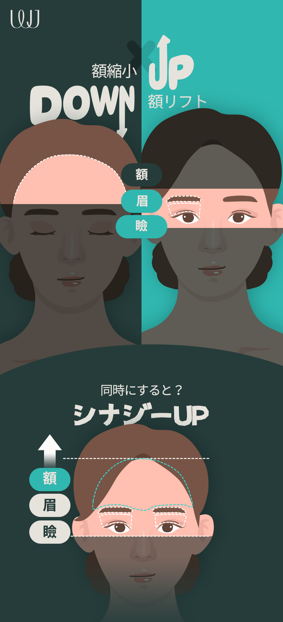 Hướng đến cải thiện trán rộng với phẫu thuật thu nhỏ trán｜Chỉnh sửa đường chân tóc đồng thời｜WJ Wonjin Thẩm mỹ (ga Gangnam)