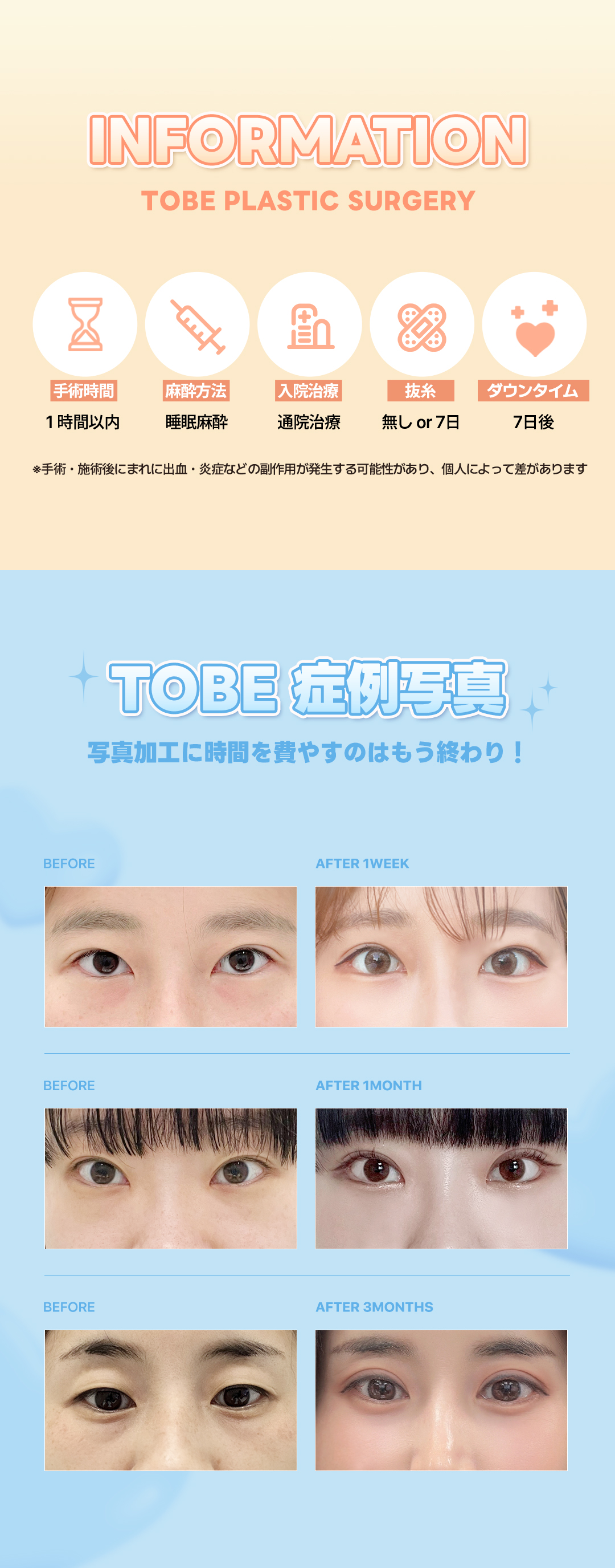 Tái phân bổ mỡ dưới mắt + tạo mắt đuôi cá đồng thời cho vùng mắt trẻ trung | Thẩm mỹ viện TOBE Gangnam Sinsa