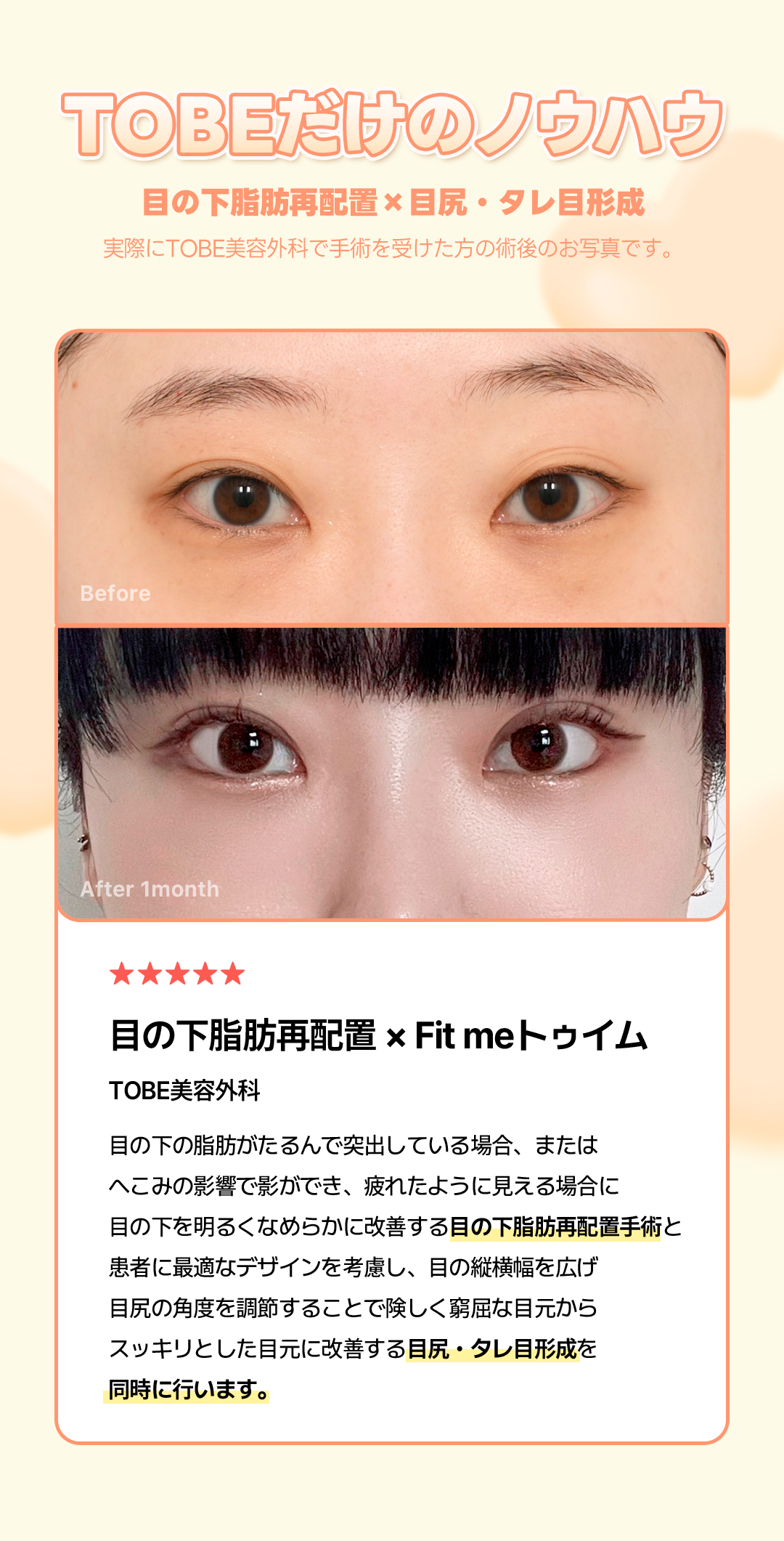 Tái phân bổ mỡ dưới mắt + tạo mắt đuôi cá đồng thời cho vùng mắt trẻ trung | Thẩm mỹ viện TOBE Gangnam Sinsa