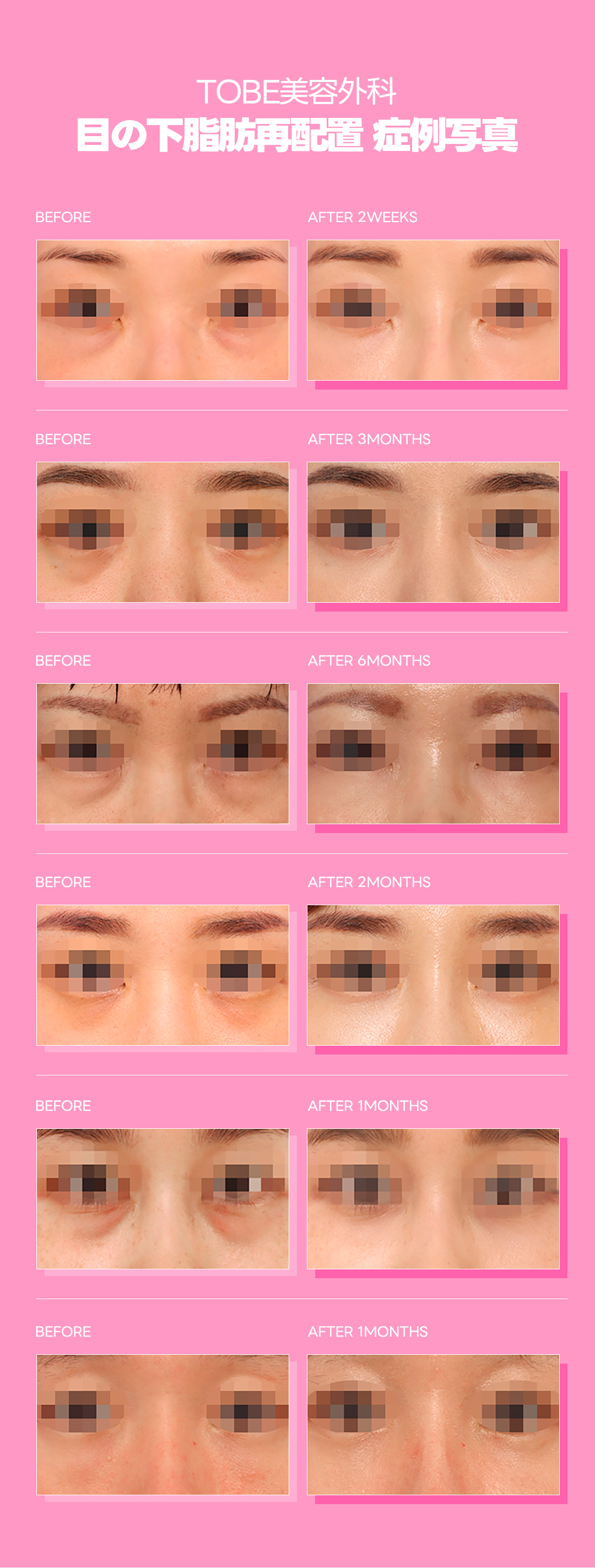 Tái phân bổ mỡ dưới mắt | Rạch kết mạc khó thấy sẹo | Hướng tới cải thiện quầng thâm | TOBE Thẩm mỹ Ngoại khoa