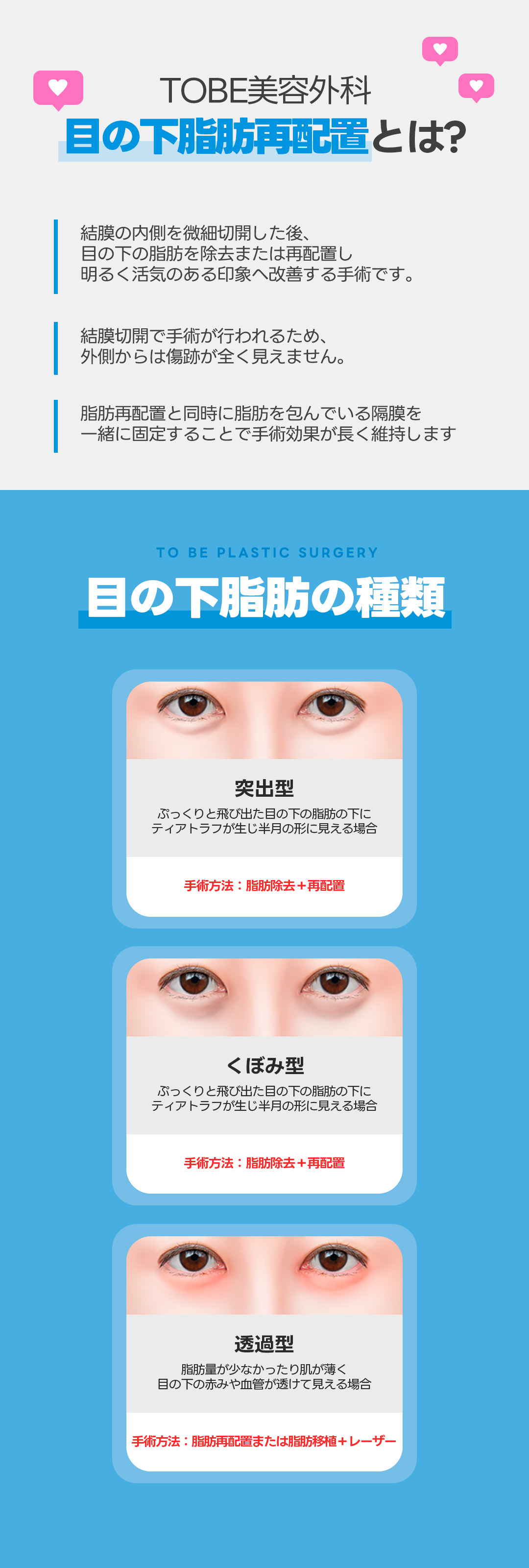 Tái phân bổ mỡ dưới mắt | Rạch kết mạc khó thấy sẹo | Hướng tới cải thiện quầng thâm | TOBE Thẩm mỹ Ngoại khoa