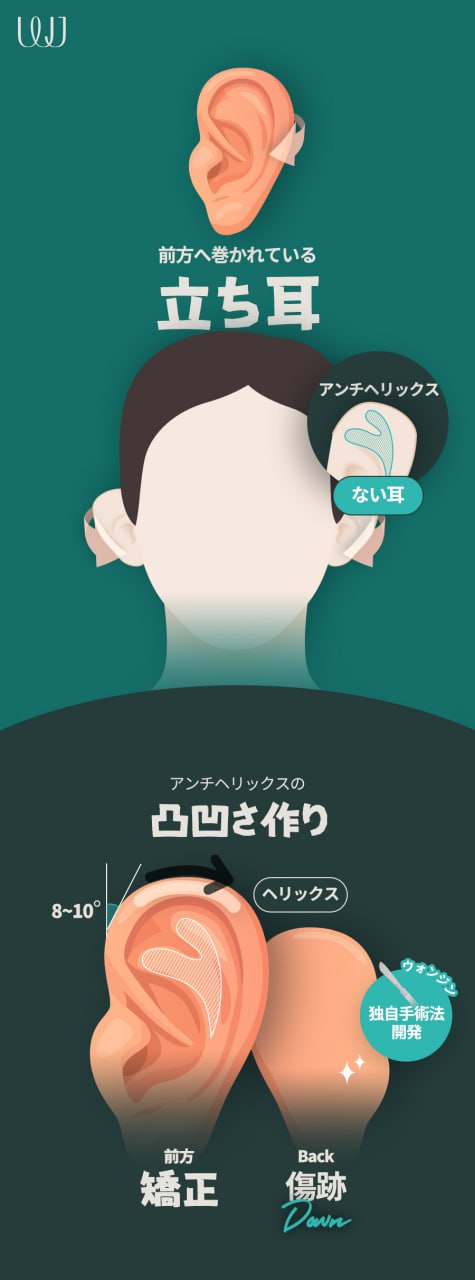 Tạo hình tai lý tưởng | Liệu pháp đáp ứng nhiều vấn đề tai như tai vểnh, tai gấp, tiểu nhĩ