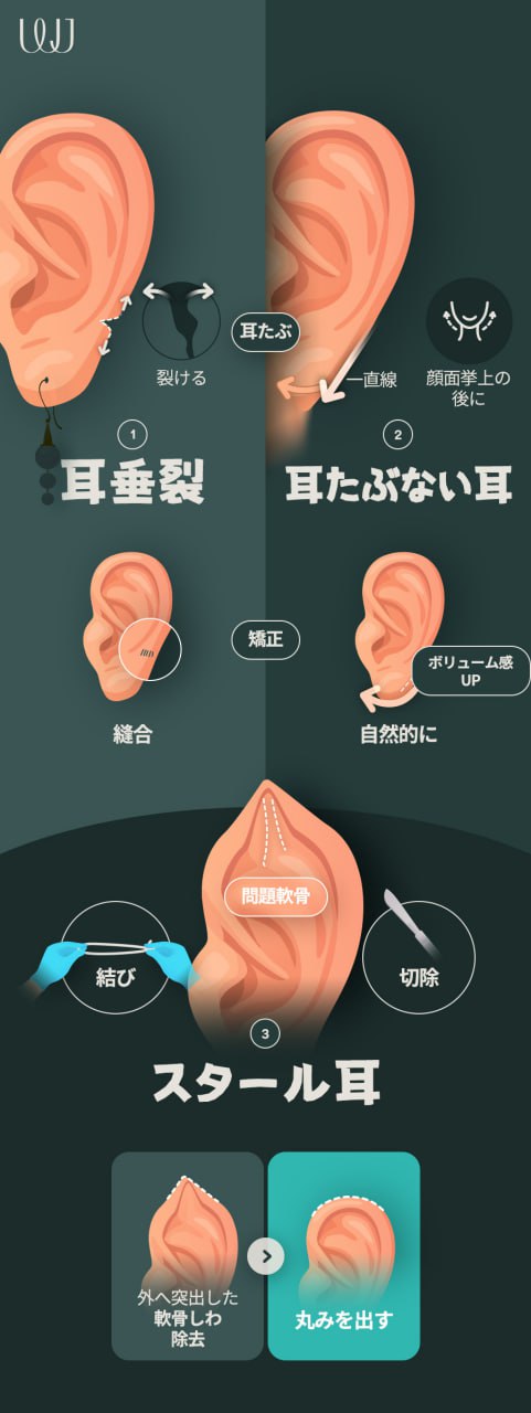 Tạo hình tai lý tưởng | Liệu pháp đáp ứng nhiều vấn đề tai như tai vểnh, tai gấp, tiểu nhĩ