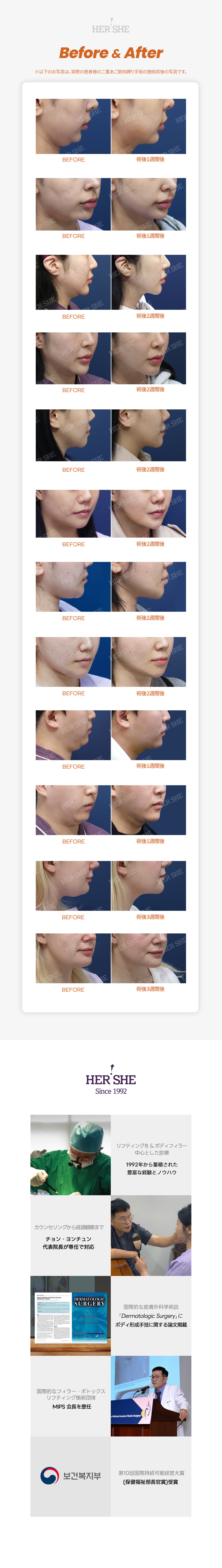 Buộc cơ nọng cằm và hút mỡ | HERSHE mở cửa năm 1992 | Tạo hình contour Cheongdam