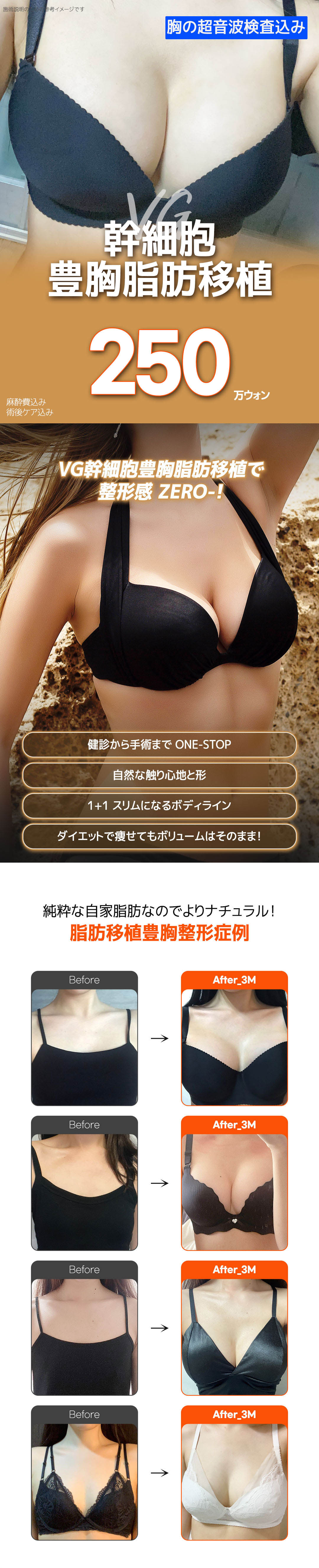 Seoul Gangnam・Nâng ngực bằng mỡ tế bào gốc hướng tới vòng một tự nhiên｜Very Good Plastic Surgery