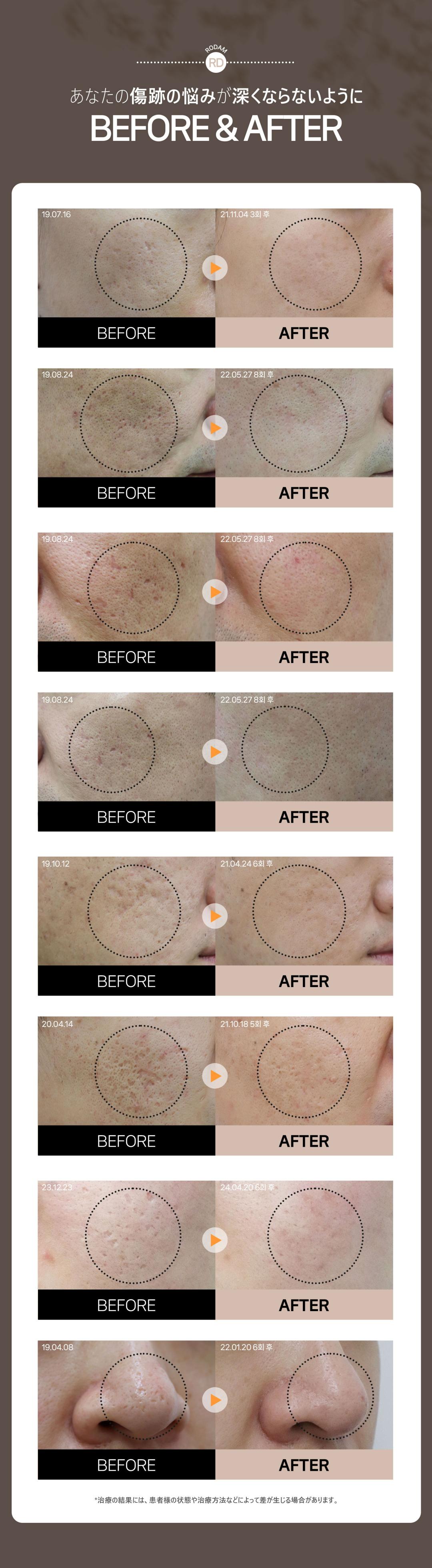 Điều trị sẹo mụn và sẹo rỗ Colatherapy lần đầu 5,413 yên | Liệu trình chuyên về sẹo được cấp bằng sáng chế | Rodam Hàn y viện Busan