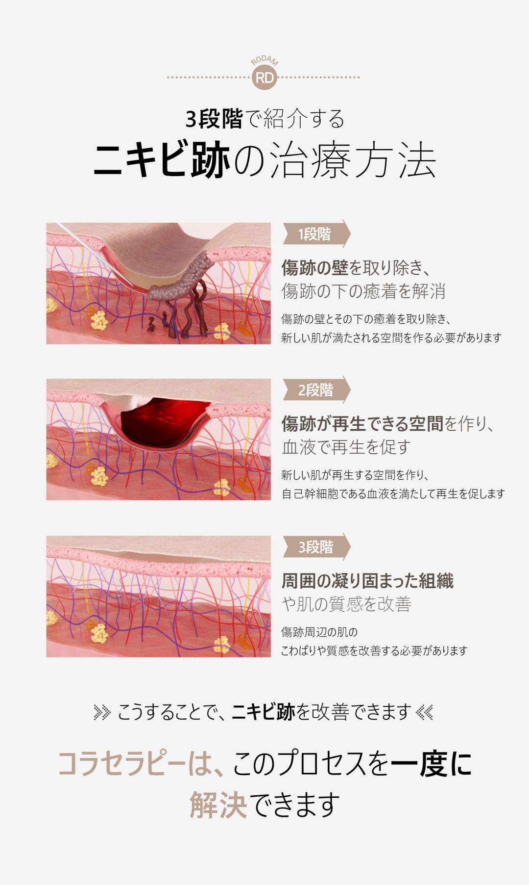 Điều trị sẹo mụn và sẹo rỗ Colatherapy lần đầu 5,413 yên | Liệu trình chuyên về sẹo được cấp bằng sáng chế | Rodam Hàn y viện Busan