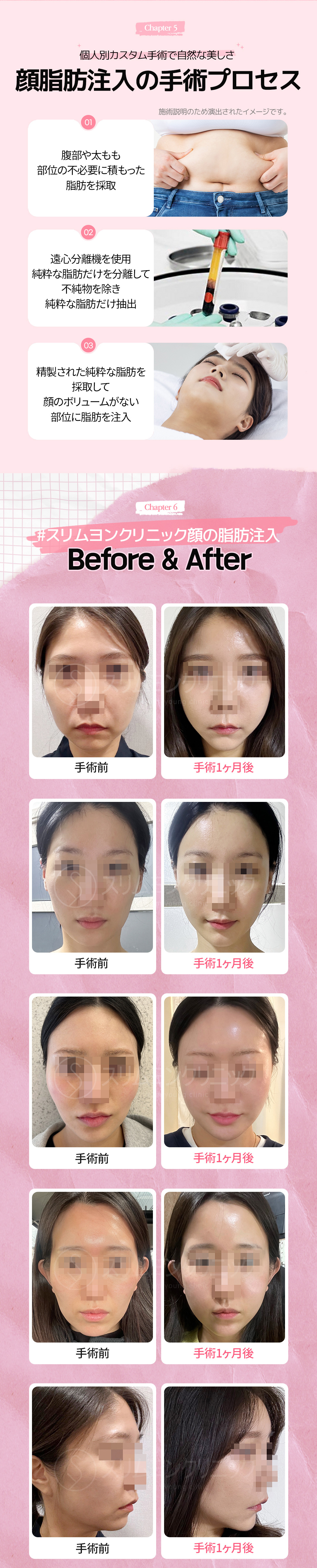 Ghép mỡ mặt｜Seoul Myeongdong Slim Yong Clinic｜Thủ thuật tùy chỉnh hướng tới cải thiện volume tự nhiên