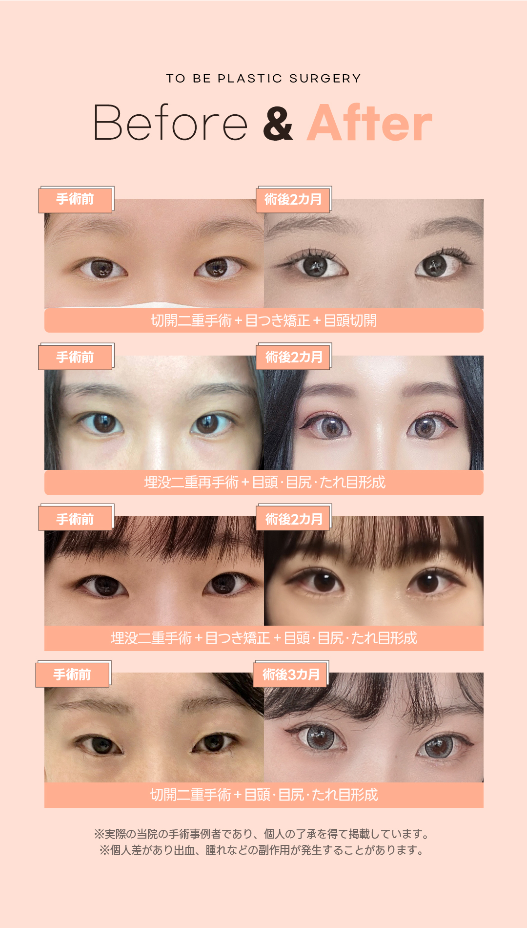 Dual Tuim không cắt (đuôi mắt + tạo hình mắt xệ) mở rộng mắt tự nhiên | TOBE Plastic Surgery【Ga Gangnam Sinsa】