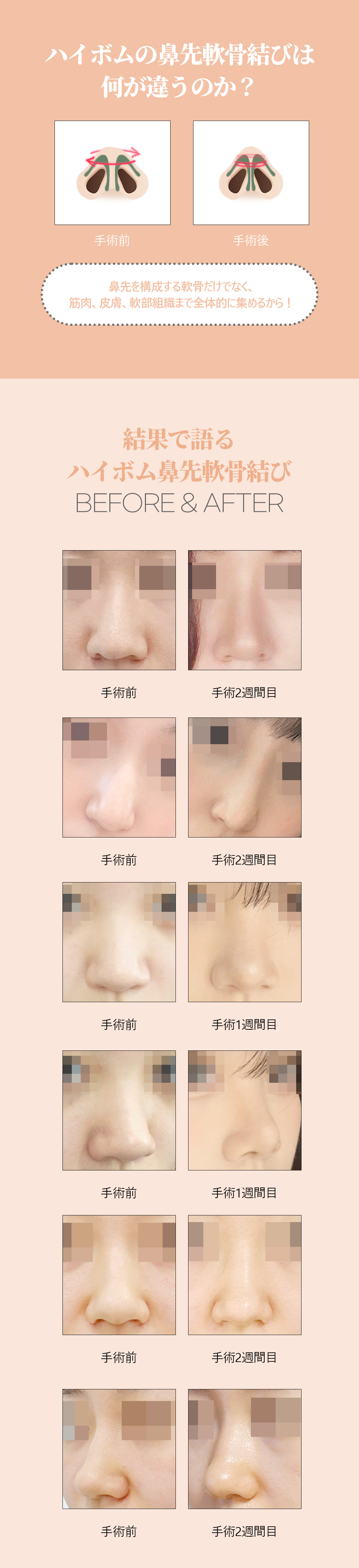 Kết sụn đầu mũi | Kỳ vọng cải thiện đầu mũi tự nhiên không dùng silicon Seoul・Highbeom Phẫu thuật Thẩm mỹ