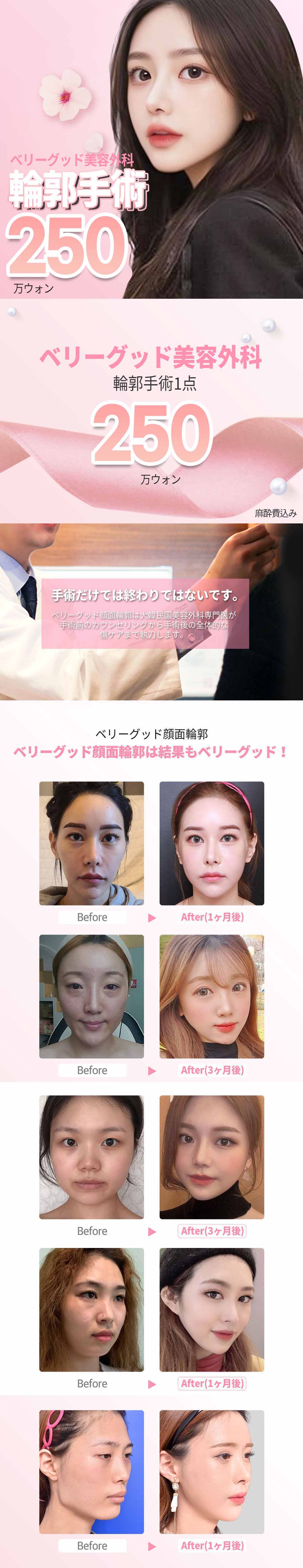 【Tạo hình đường viền Hàn Quốc】Tạo hình đường viền mặt 1 điểm Very Good Thẩm mỹ｜Chẩn đoán chính xác 3D-CT × Bác sĩ chuyên khoa thực hiện｜Cách ga Gangnam 1 phút đi bộ