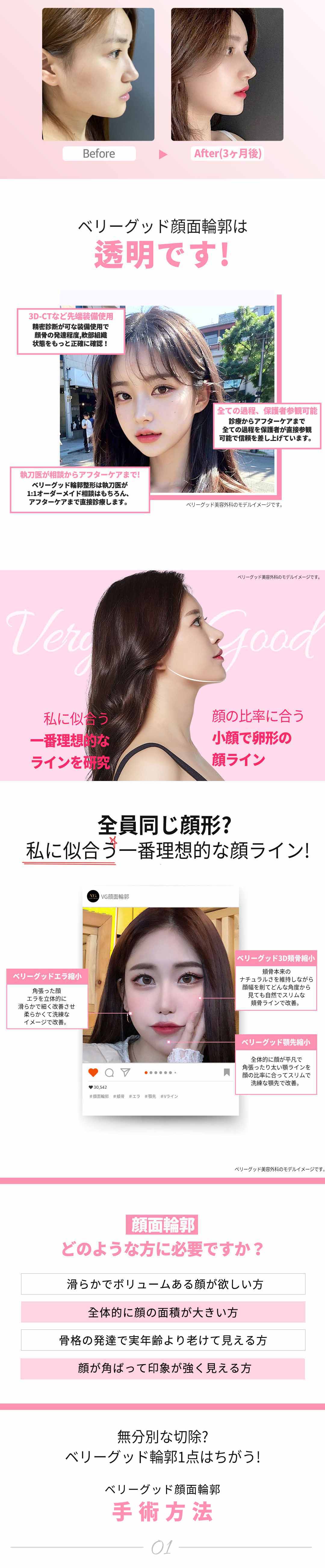 【Tạo hình đường viền Hàn Quốc】Tạo hình đường viền mặt 1 điểm Very Good Thẩm mỹ｜Chẩn đoán chính xác 3D-CT × Bác sĩ chuyên khoa thực hiện｜Cách ga Gangnam 1 phút đi bộ