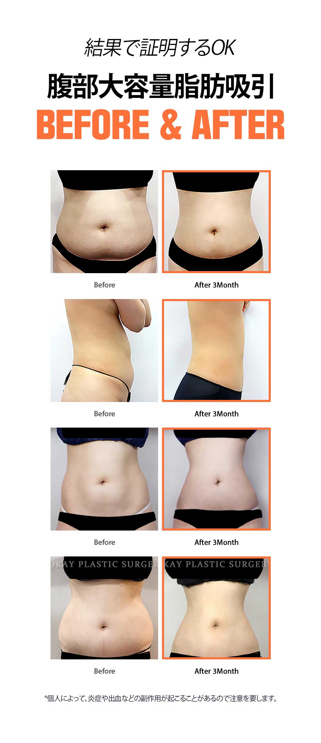 Hút mỡ bụng dung lượng lớn tại OK Clinic Hàn Quốc | Ống hút siêu nhỏ coi trọng an toàn, giảm tổn thương | Seoul Gangnam