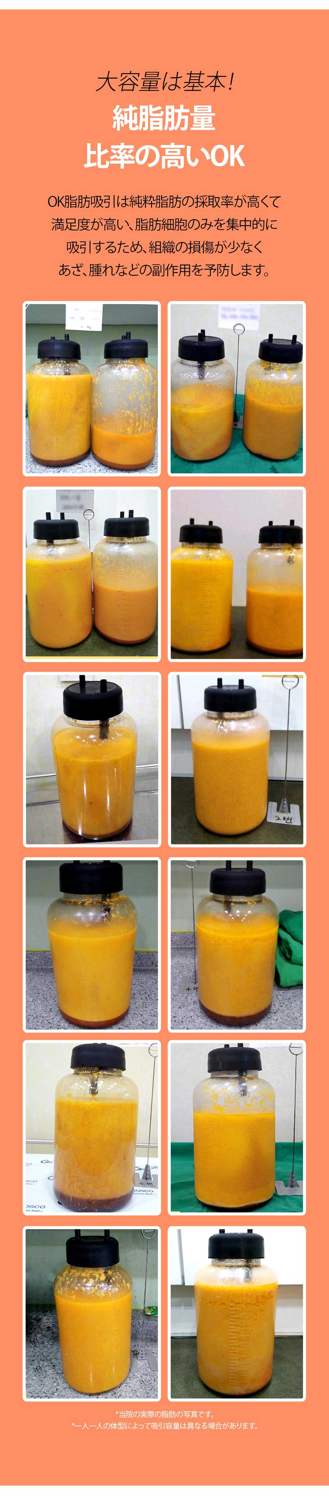 Hút mỡ bụng dung lượng lớn tại OK Clinic Hàn Quốc | Ống hút siêu nhỏ coi trọng an toàn, giảm tổn thương | Seoul Gangnam