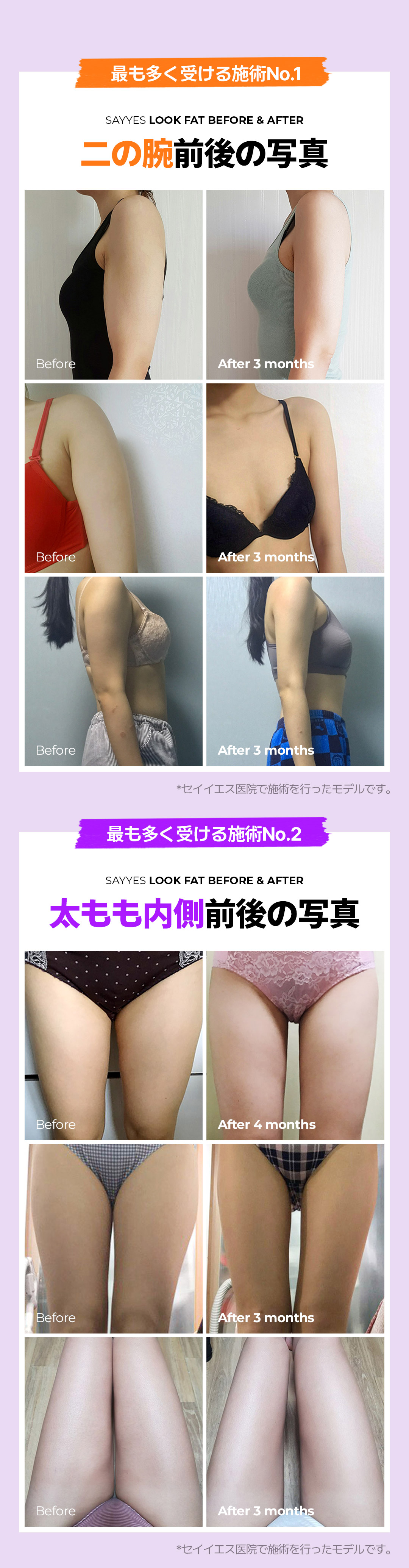 Tiêm hút mỡ Look Fat hướng đến giảm mỡ cục bộ | Sử dụng cannula siêu nhỏ 2mm | Say Yes Clinic Seoul Gangnam