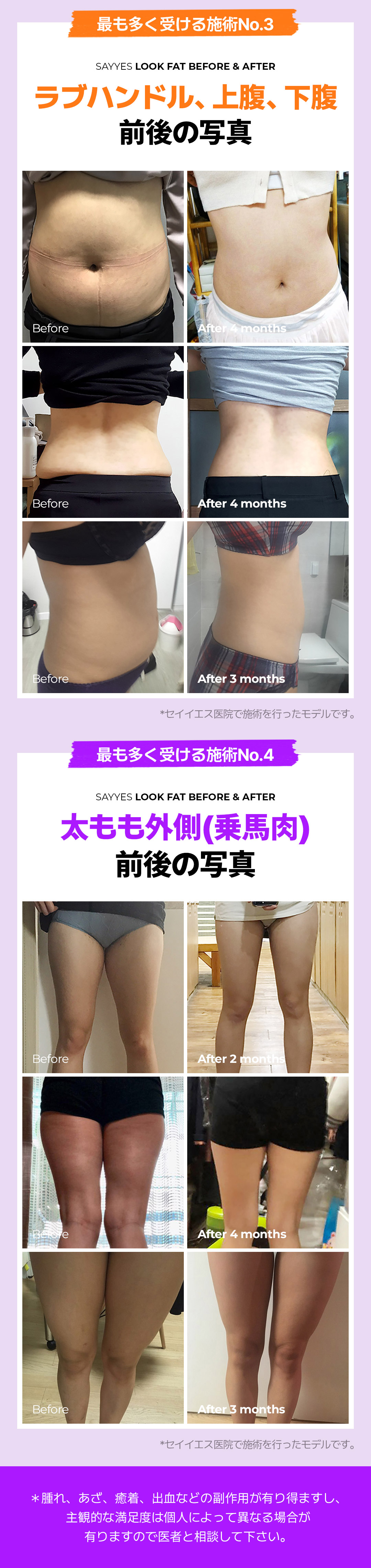 Tiêm hút mỡ Look Fat hướng đến giảm mỡ cục bộ | Sử dụng cannula siêu nhỏ 2mm | Say Yes Clinic Seoul Gangnam