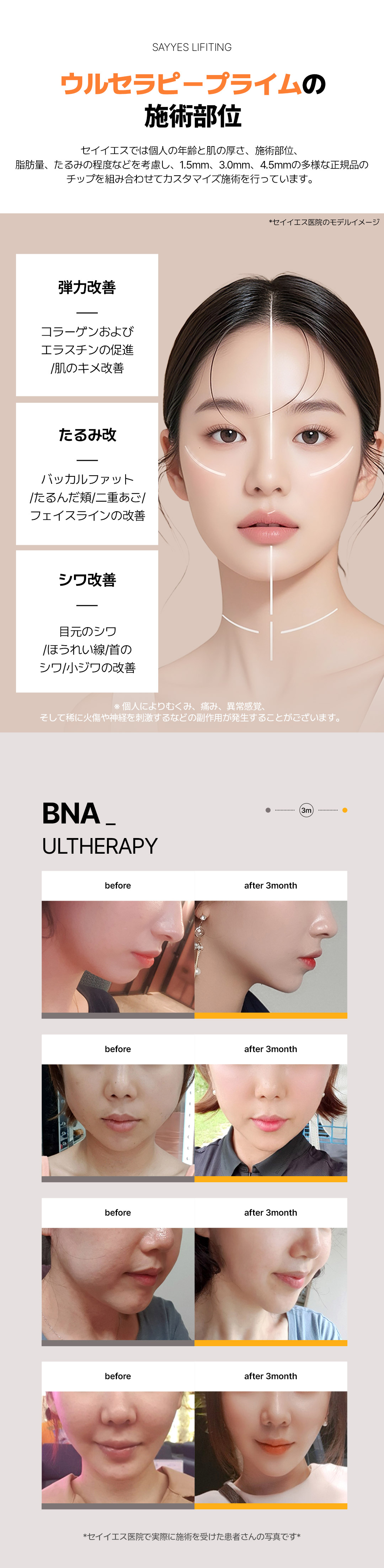 Ultherapy Prime 300 shot | Nâng cơ FDA | Say Yes Clinic Gangnam