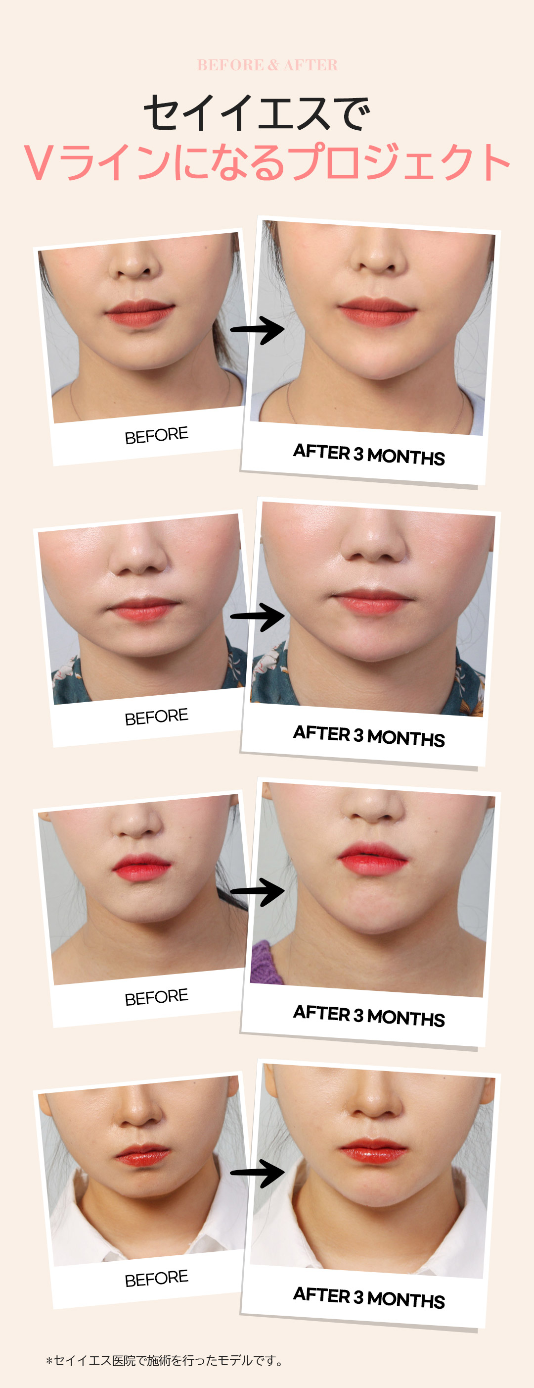 Tiêm tan mỡ đường viền + Botox hàm hướng đến gọn mặt V-line｜Từ 3.930 yên｜Phòng khám Say Yes｜Gangnam Hàn Quốc