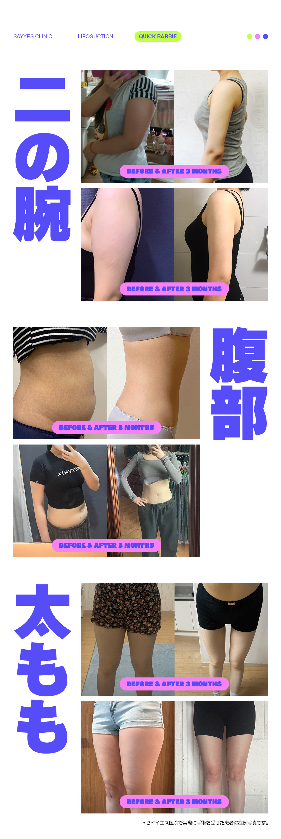 Hút mỡ Quick Barbie Line | Giảm mỡ cục bộ bắp tay, bụng, đùi | Say Yes