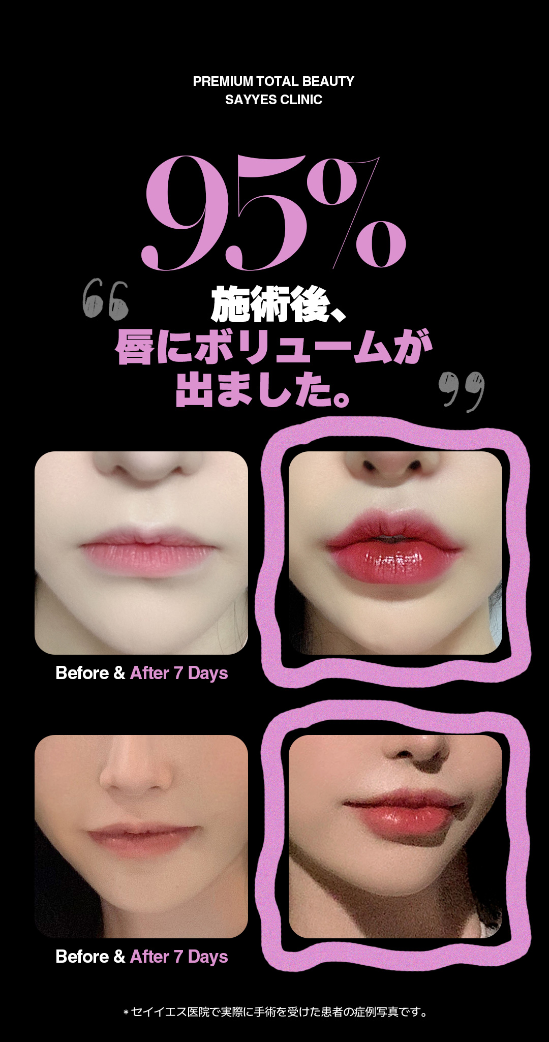 Điều trị Lip Set Gangnam Hàn Quốc (filler môi + filler khóe miệng + botox) hướng đến vùng miệng lý tưởng | Say Yes Phòng khám