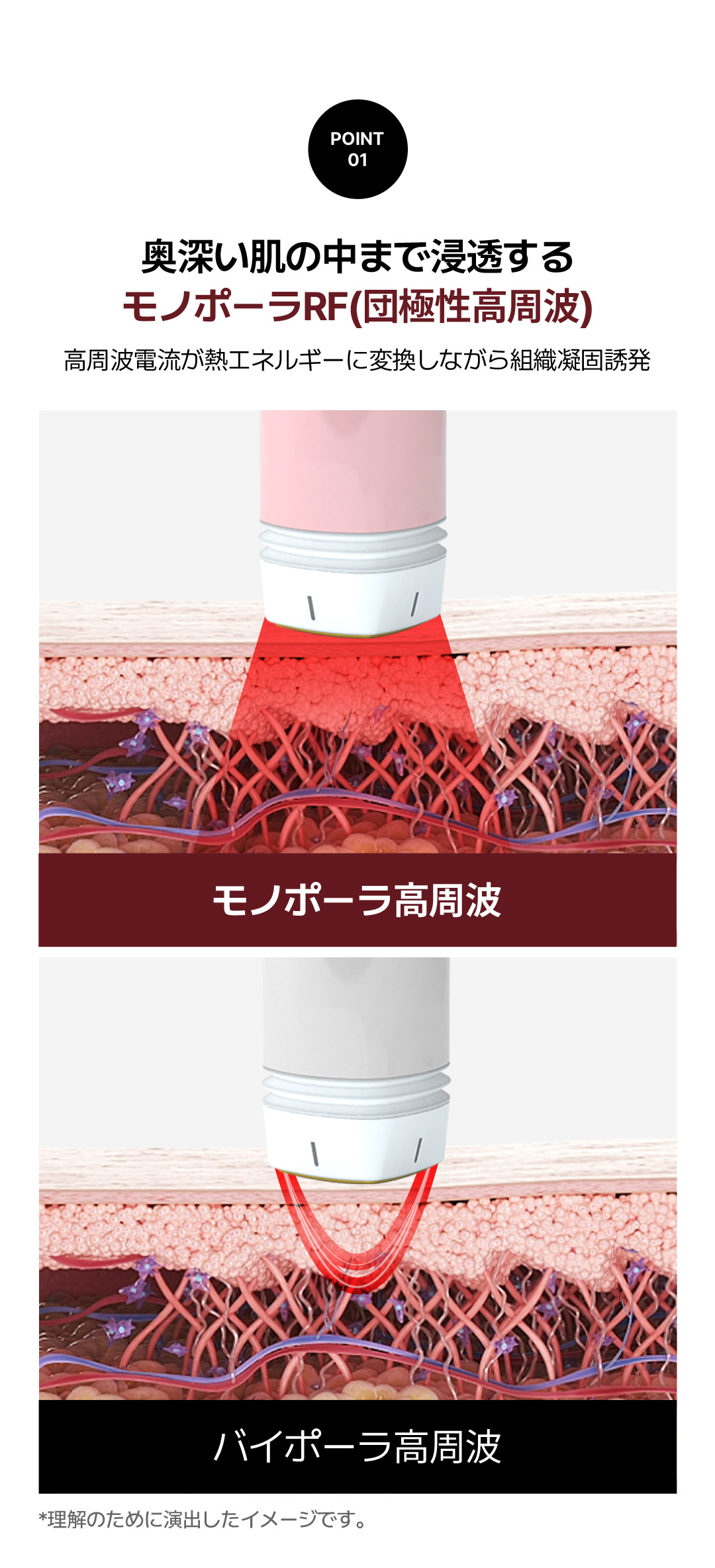 Volnewma Lift 300 Shot | RF Lifting giảm đau chăm sóc độ đàn hồi da | Say Yes Clinic