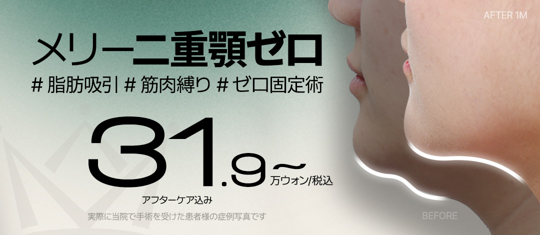 Hút mỡ nọng cằm + buộc cơ + phẫu thuật cố định Zero | Phân tích 3D-CT chính xác tạo V-line | Thẩm mỹ viện Merry Apgujeong