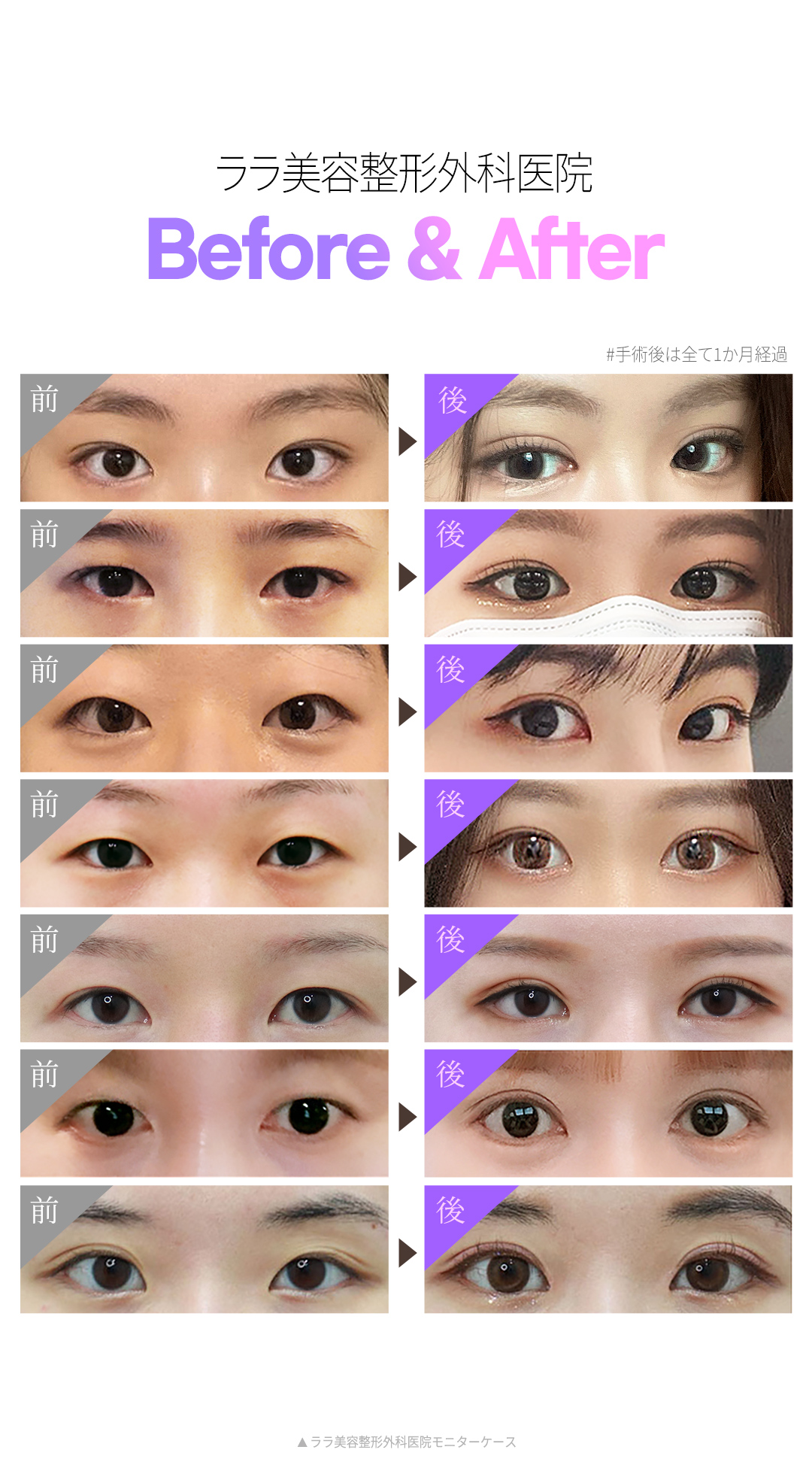 【Gangnam Hàn Quốc】Gói phẫu thuật mắt 3in1 (Mí đôi + Cắt đầu mắt + Điều chỉnh sụp mí) | Bác sĩ chuyên khoa tốt nghiệp ĐH Seoul thực hiện | Lala Thẩm mỹ