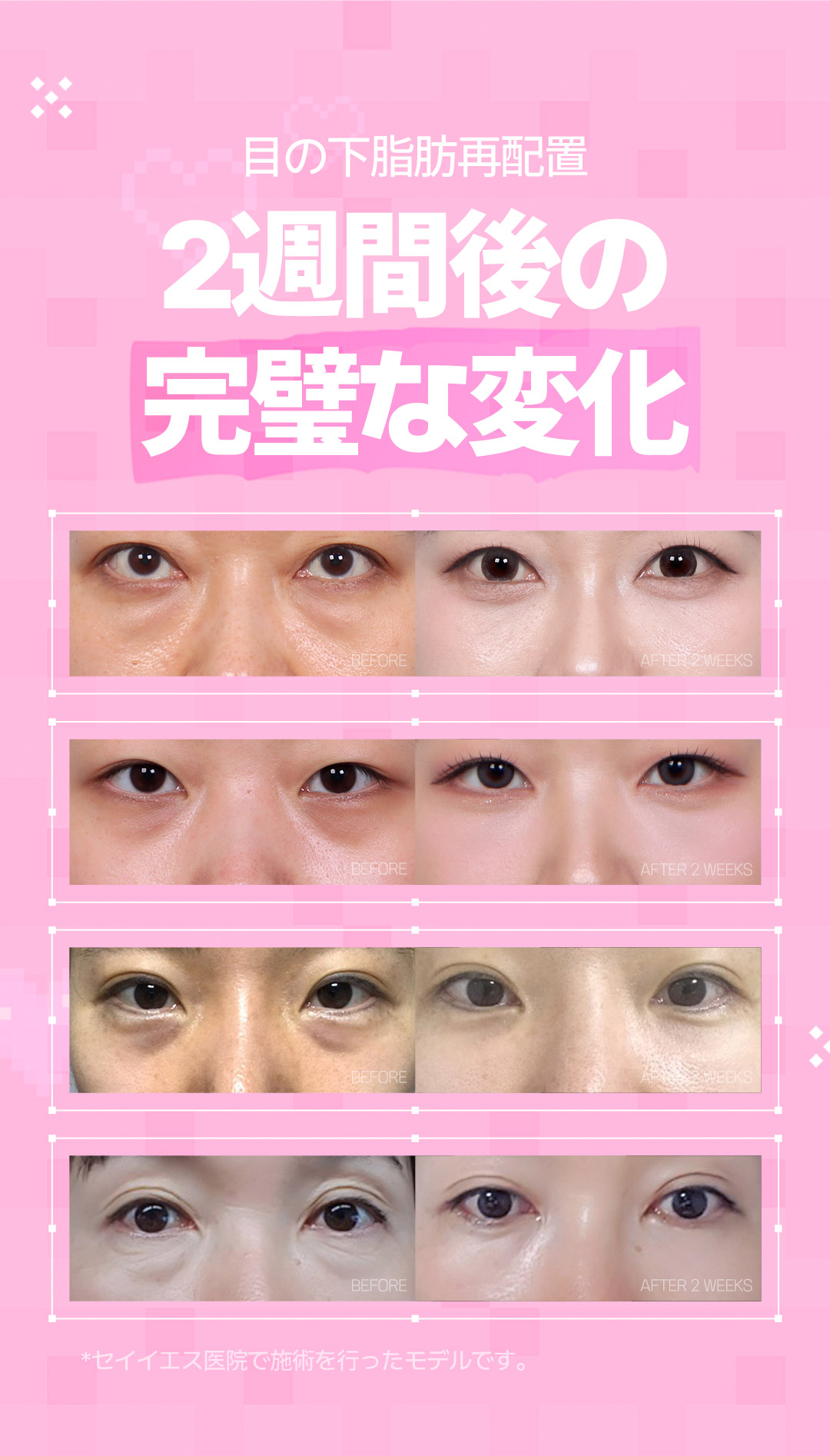 Tái phân bổ mỡ dưới mắt tạo ấn tượng trẻ trung | Giữ túi mắt, kết quả tự nhiên | Say Yes Gangnam