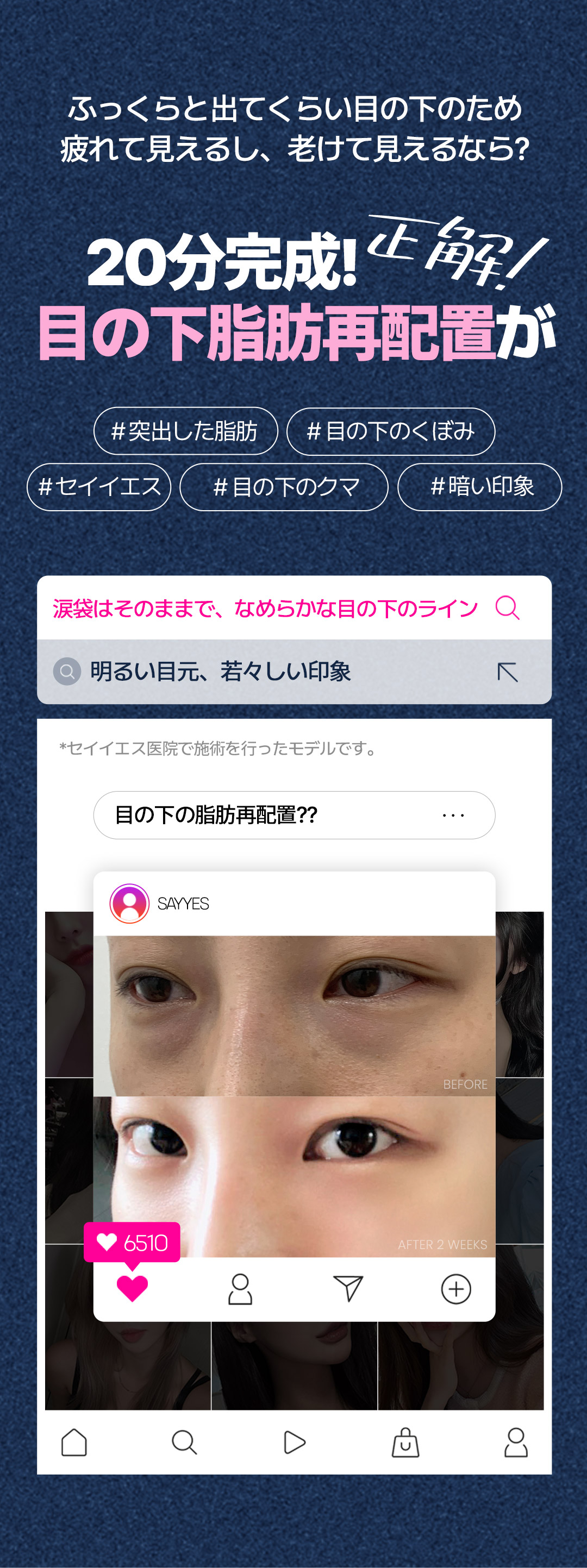 Tái phân bổ mỡ dưới mắt tạo ấn tượng trẻ trung | Giữ túi mắt, kết quả tự nhiên | Say Yes Gangnam