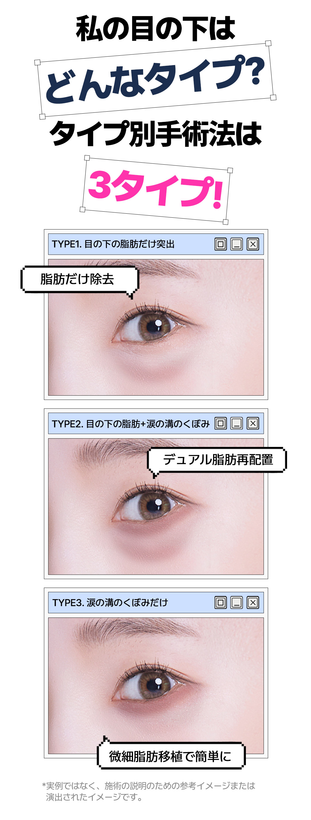 Tái phân bổ mỡ dưới mắt tạo ấn tượng trẻ trung | Giữ túi mắt, kết quả tự nhiên | Say Yes Gangnam