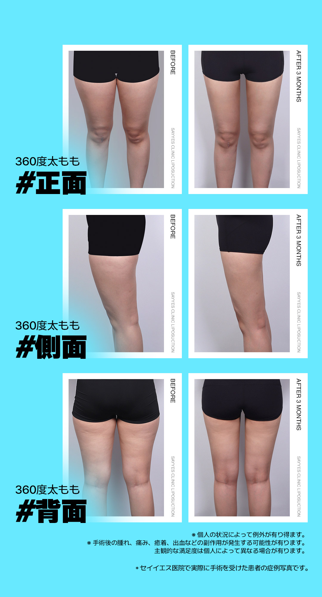 Hút mỡ đùi 360 độ tạo đường chân lý tưởng | Bác sĩ kỳ cựu phẫu thuật | Say Yes