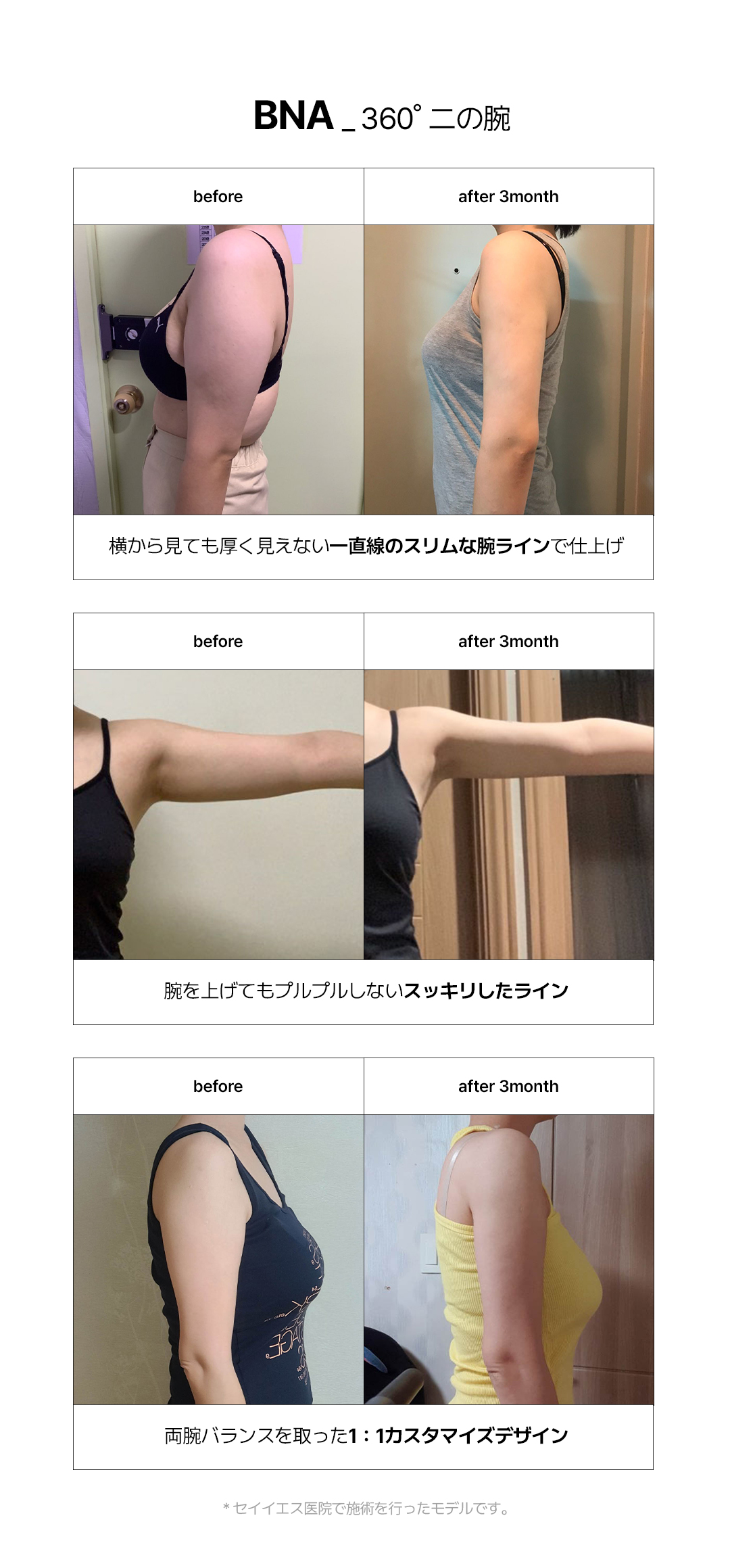 Hút mỡ bắp tay 360 độ | 2 bác sĩ trưởng đại diện trực tiếp thực hiện an tâm | Say Yes Clinic - Seoul Gangnam